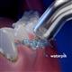 Verwendung PP-70E Pik Pocket™ Subgingivaldüse