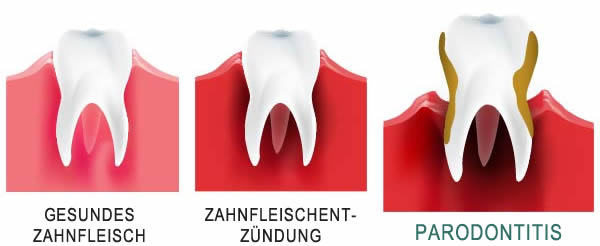 Zahnfleischentzündungen – Behandlung, Symptome, Ursachen