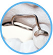 Reinigen und Putzen orthodontischer Applikationen