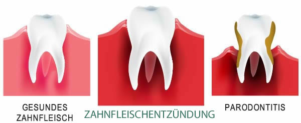 Zahnfleischentzündungen – Behandlung, Symptome, Ursachen