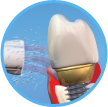 Reinigen und Putzen von Zahnimplantaten